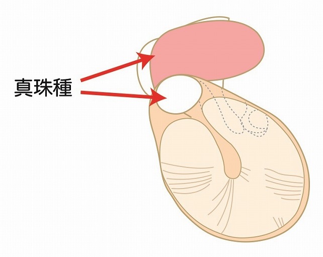 先天性と後天性がある真珠腫性中耳炎とは？