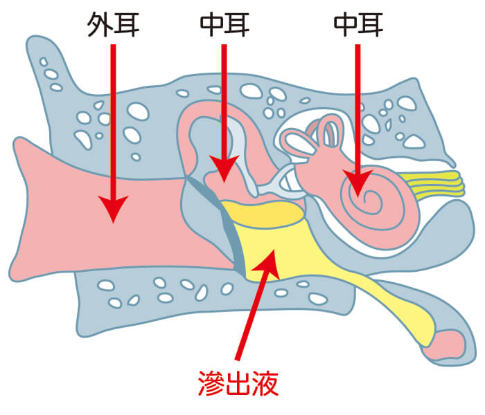 滲出性中耳炎