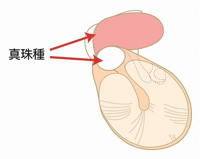 真珠腫性中耳炎（しんじゅしゅせいちゅうじえん）