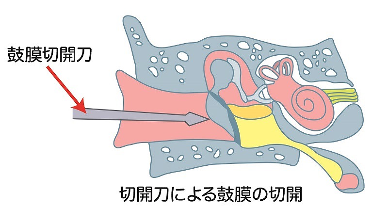 鼓膜切開（鼓膜開窓 ）