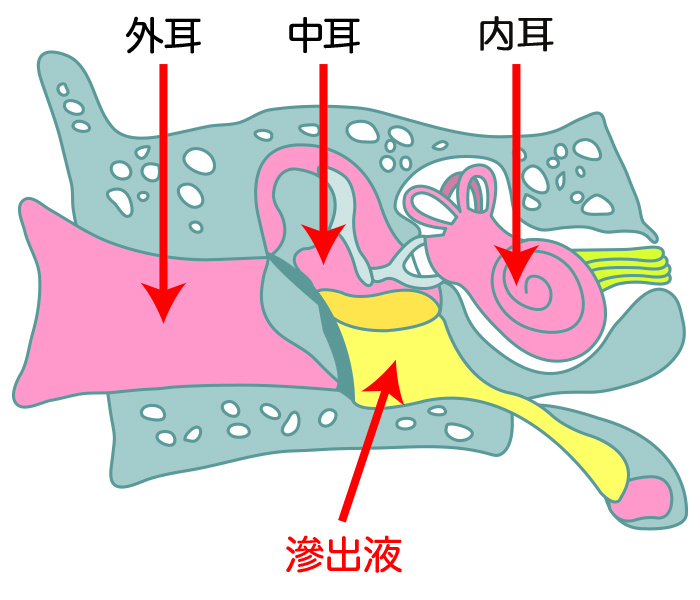 滲出性中耳炎の原因は ？